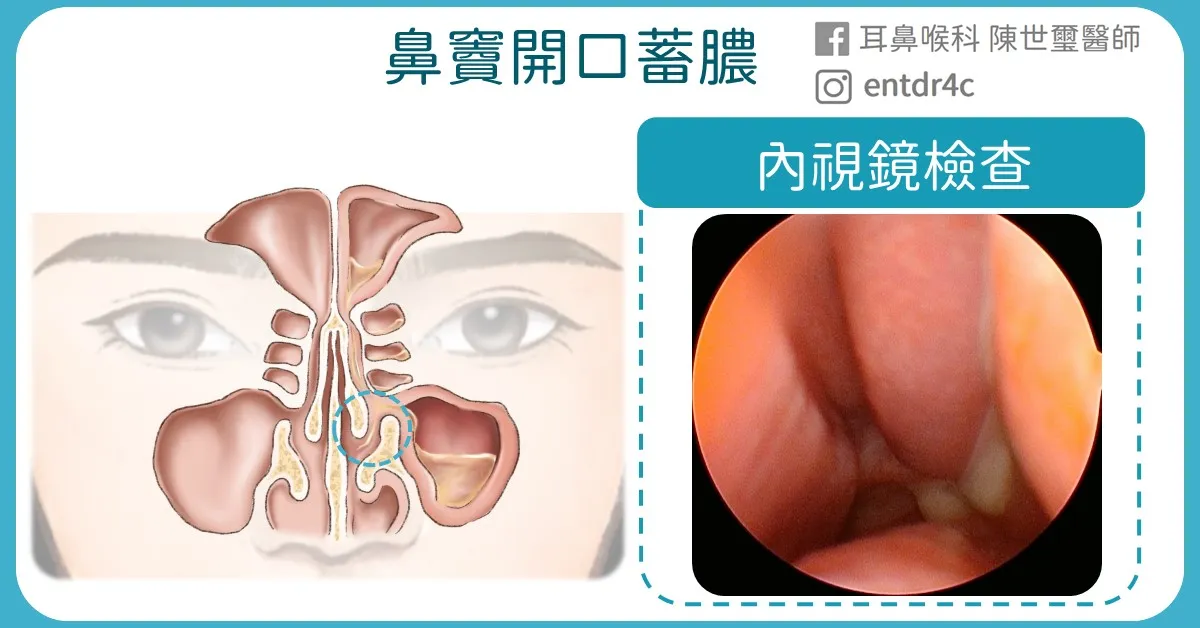 鼻竇炎內視鏡檢查