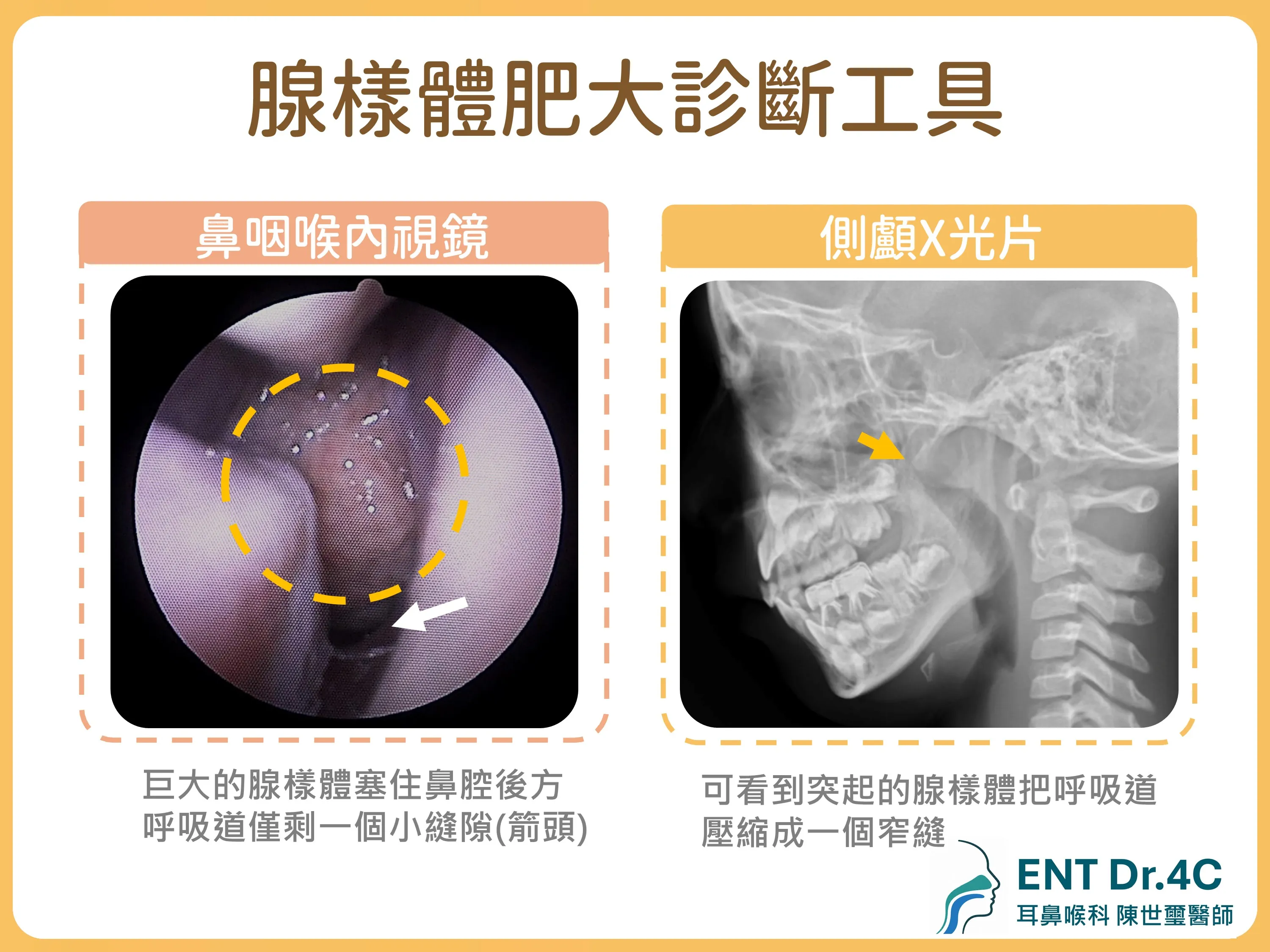 腺樣體肥大的診斷工具：鼻咽喉內視鏡與側顱 X 光片