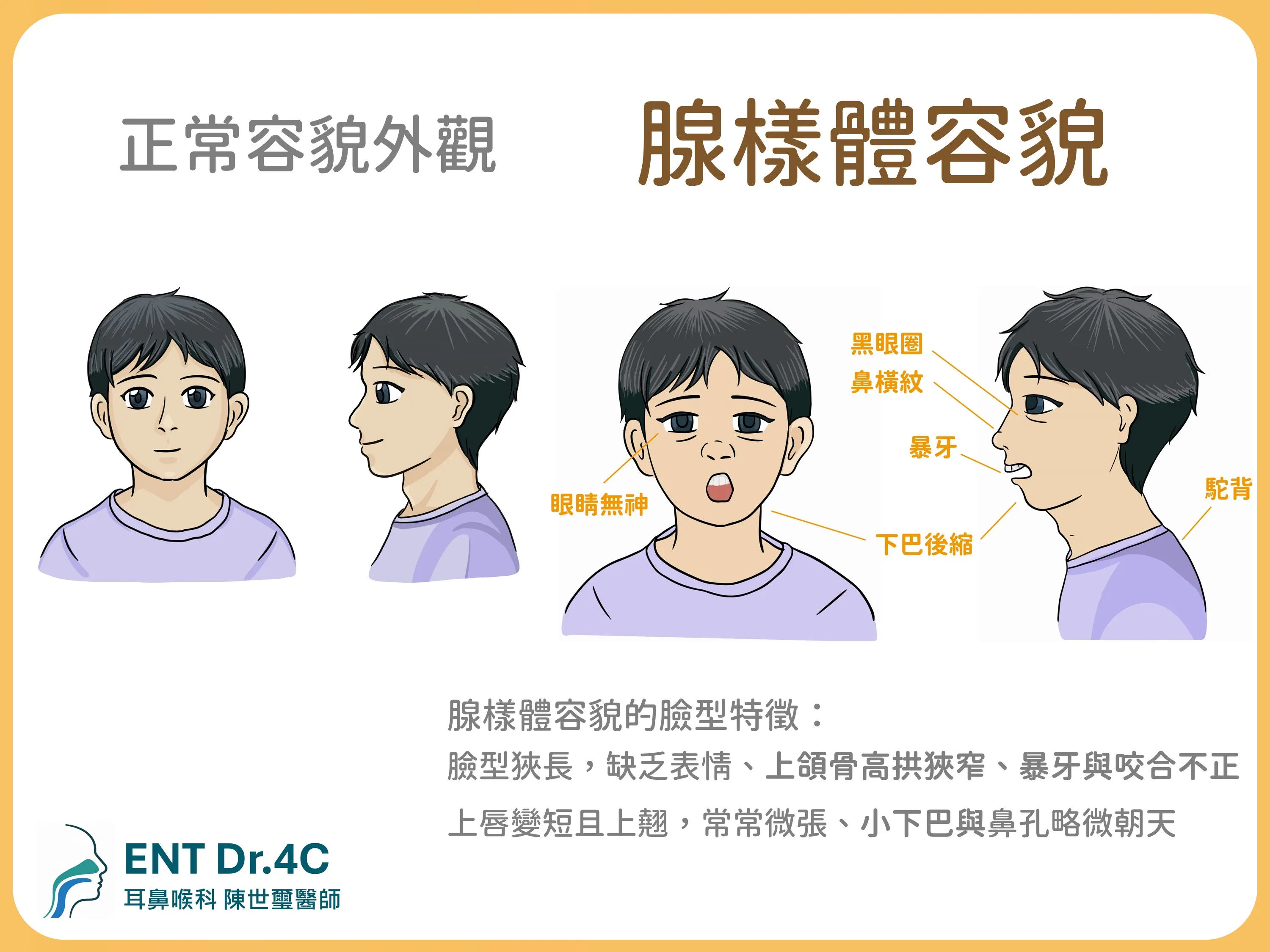 腺樣體容貌的臉型特徵：黑眼圈、鼻橫紋、暴牙、下巴後縮、駝背等