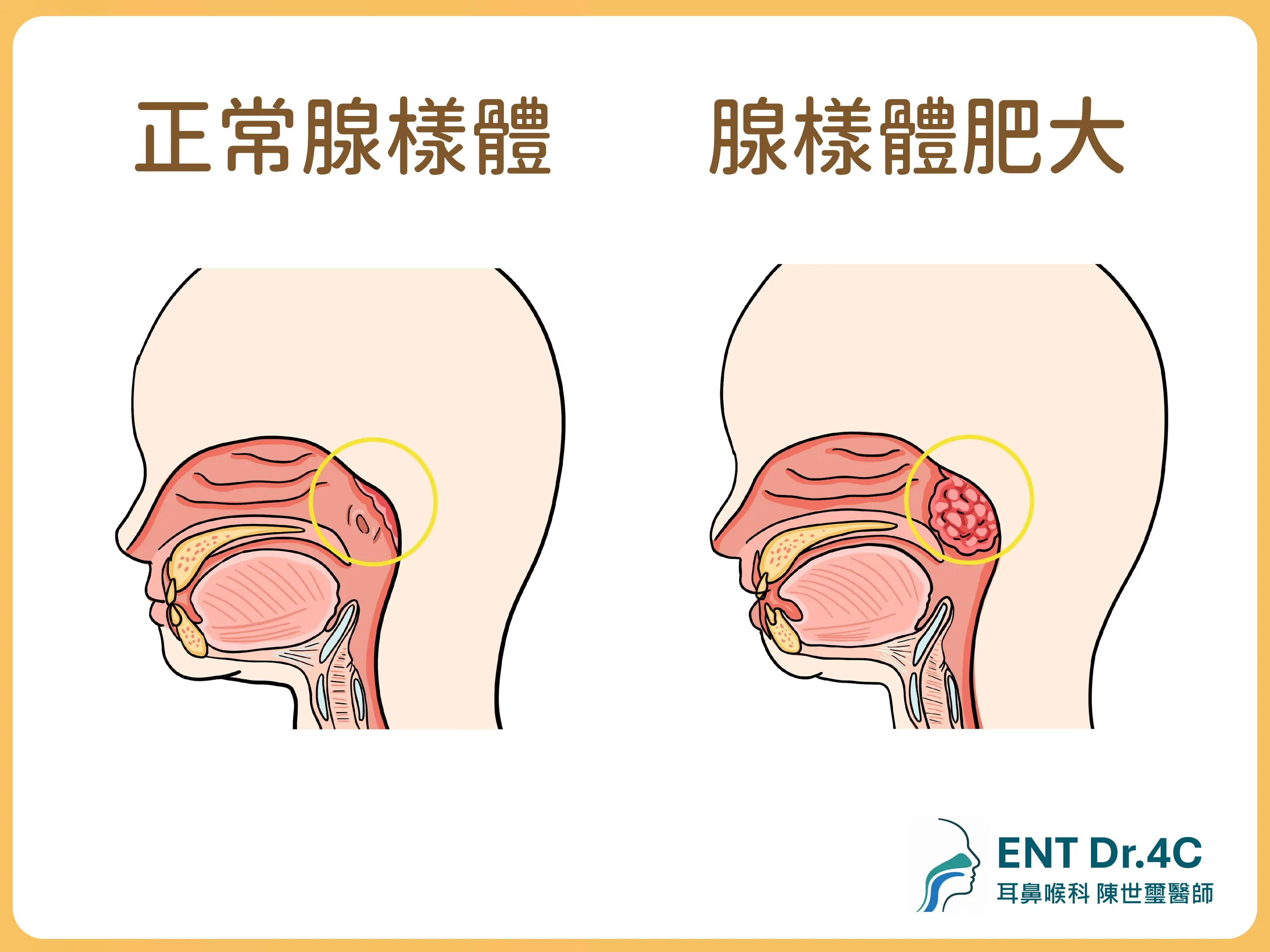 腺樣體肥大與正常腺樣體比較圖：肥大的腺樣體阻塞鼻腔後方呼吸道