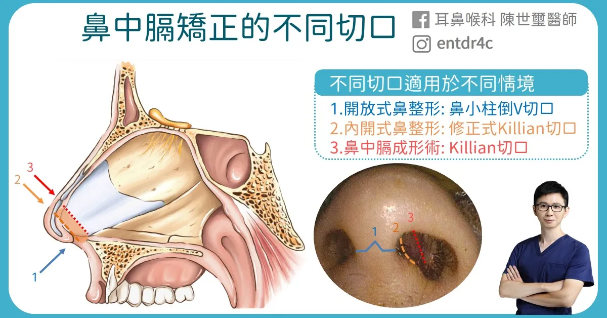 03 鼻中膈矯正的不同切口