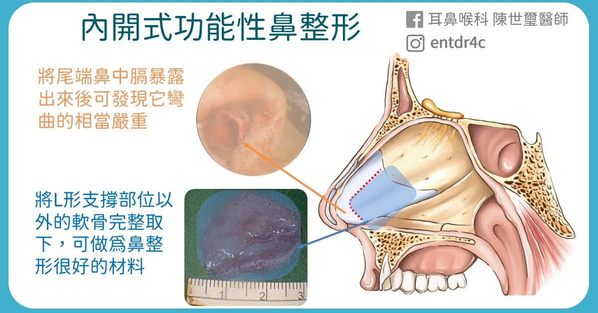 04 內開式功能性鼻整形