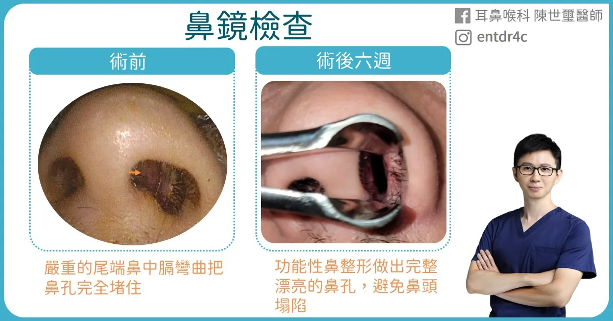 05 功能性鼻整形術前術後