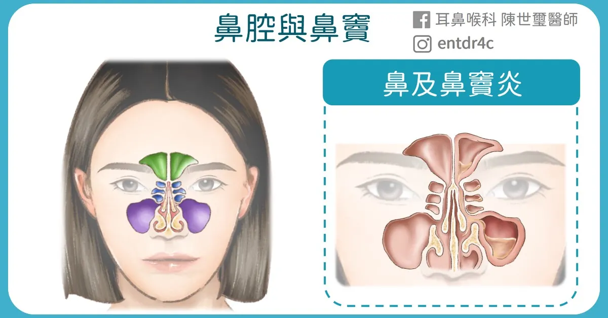 鼻及鼻竇炎 rhinosinusitis