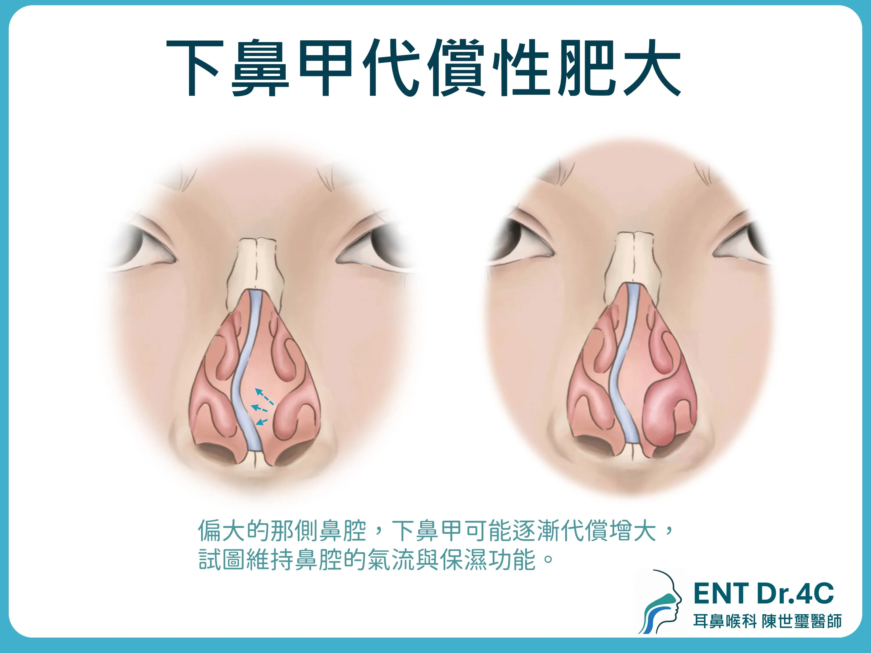 下鼻甲代償性肥大：鼻中膈偏向一側時，對側下鼻甲逐漸代償增大