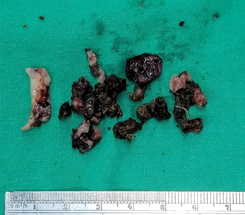 鼻子裡的黴礦