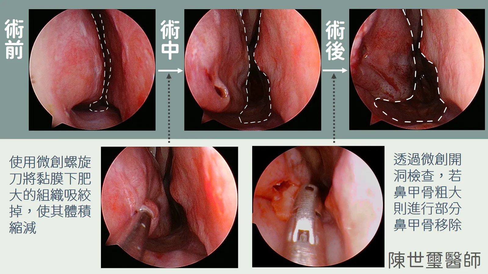 下鼻甲微創螺旋刀手術過程內視鏡圖