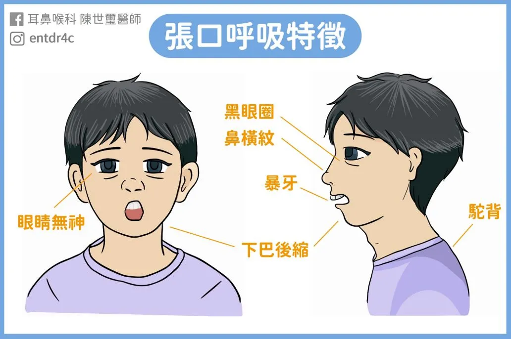 張口呼吸特徵