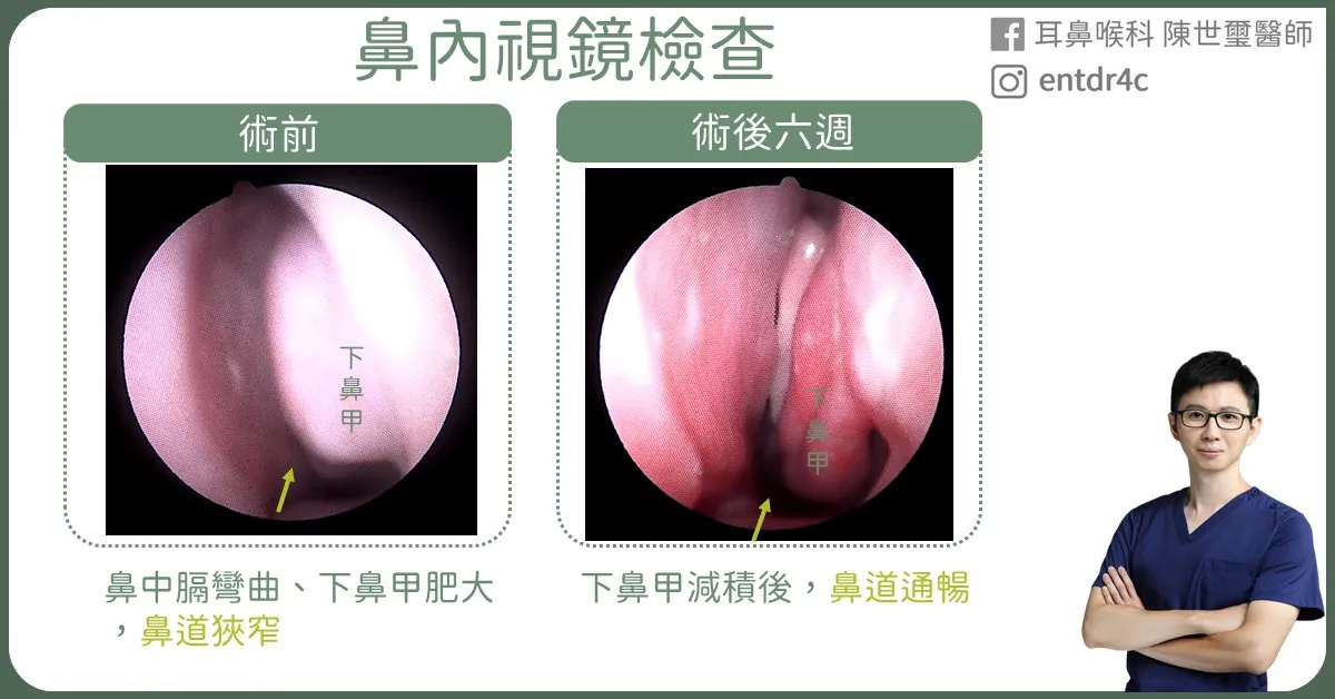 鼻塞手術前後