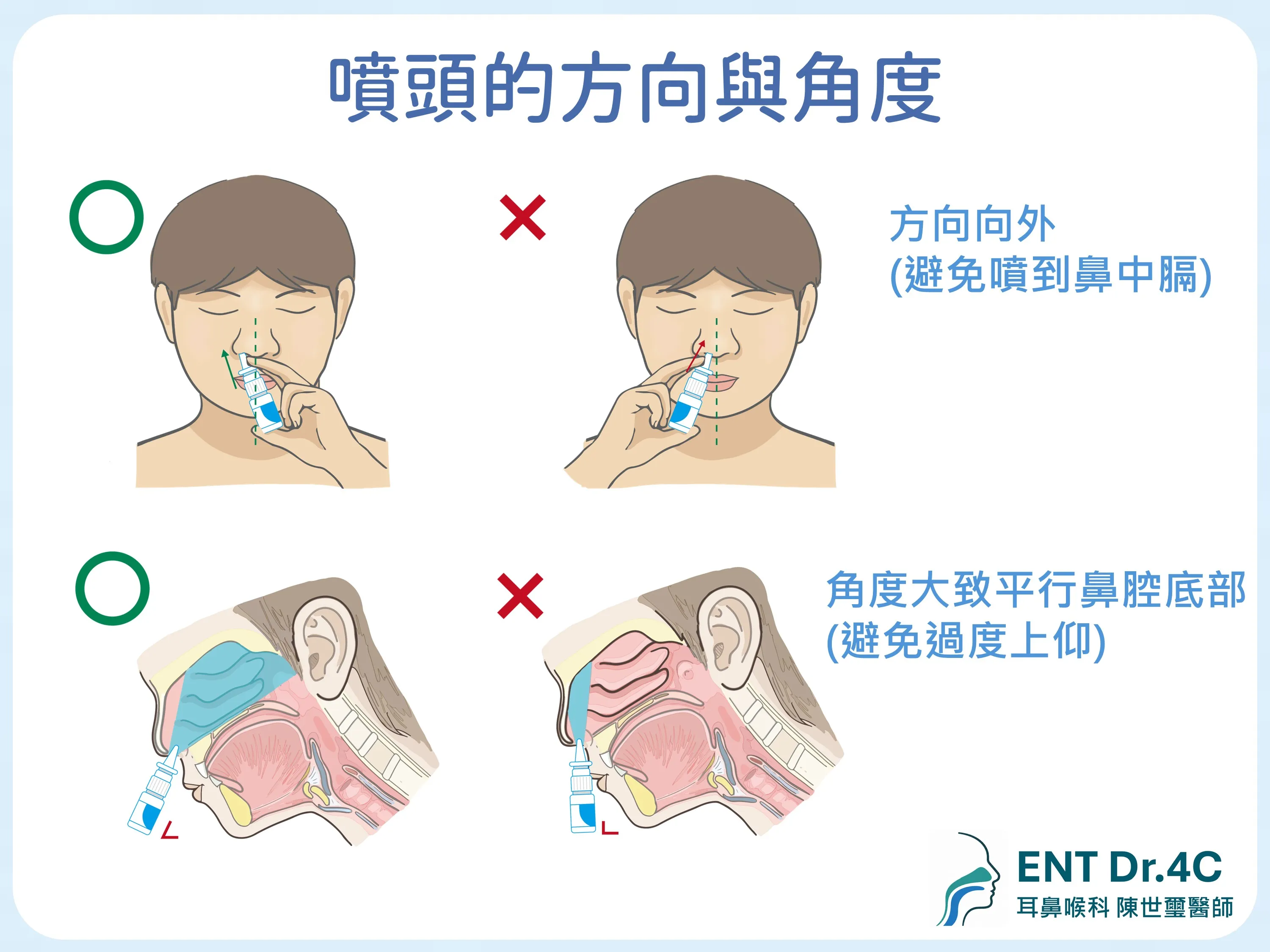 鼻噴劑噴頭的方向與角度：方向要向外避免噴到鼻中膈，角度大致平行鼻腔底部避免過度上仰