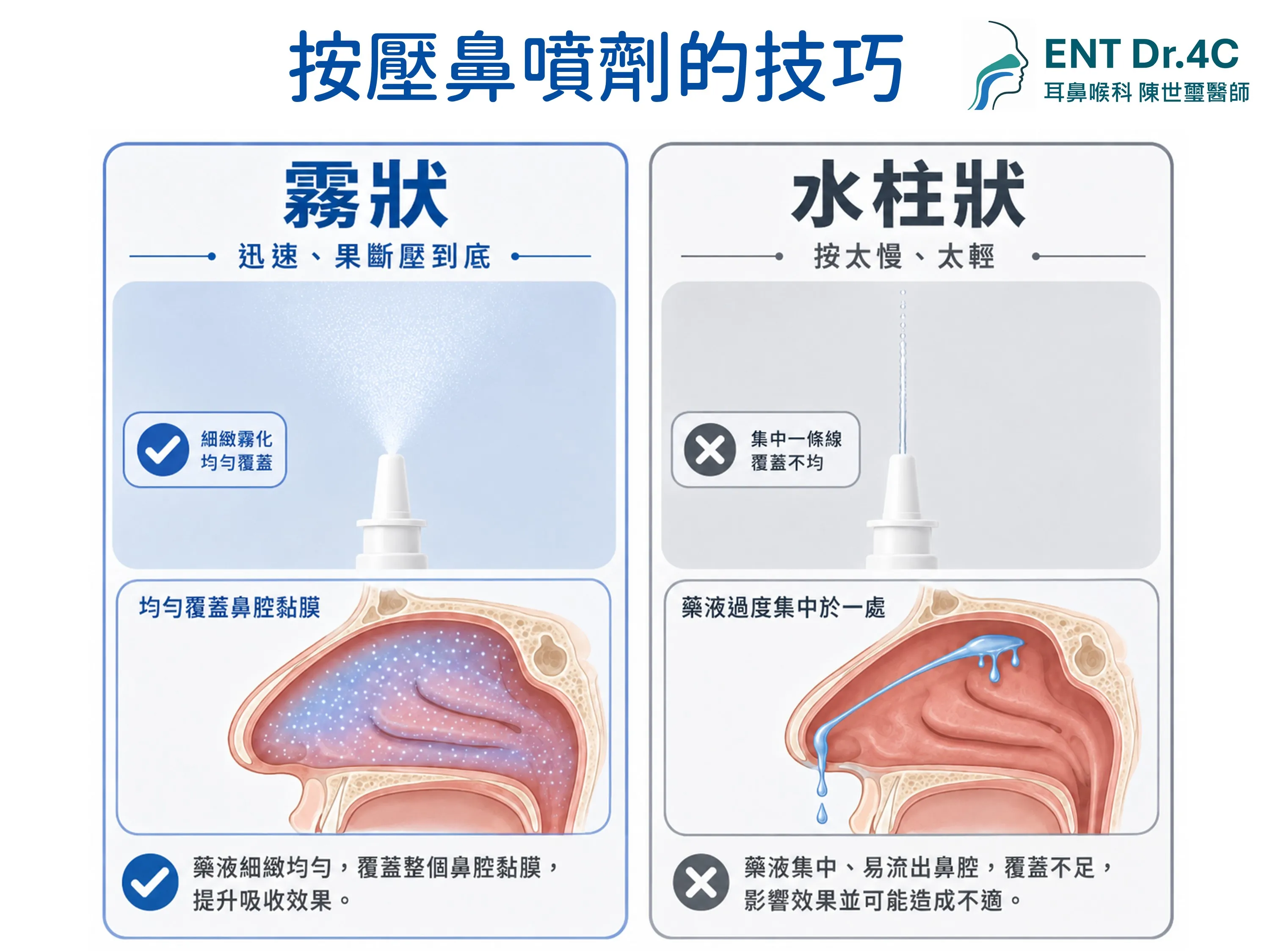 按壓鼻噴劑的技巧：迅速果斷壓到底噴出霧狀均勻覆蓋鼻腔，按太慢太輕則呈水柱狀覆蓋不均