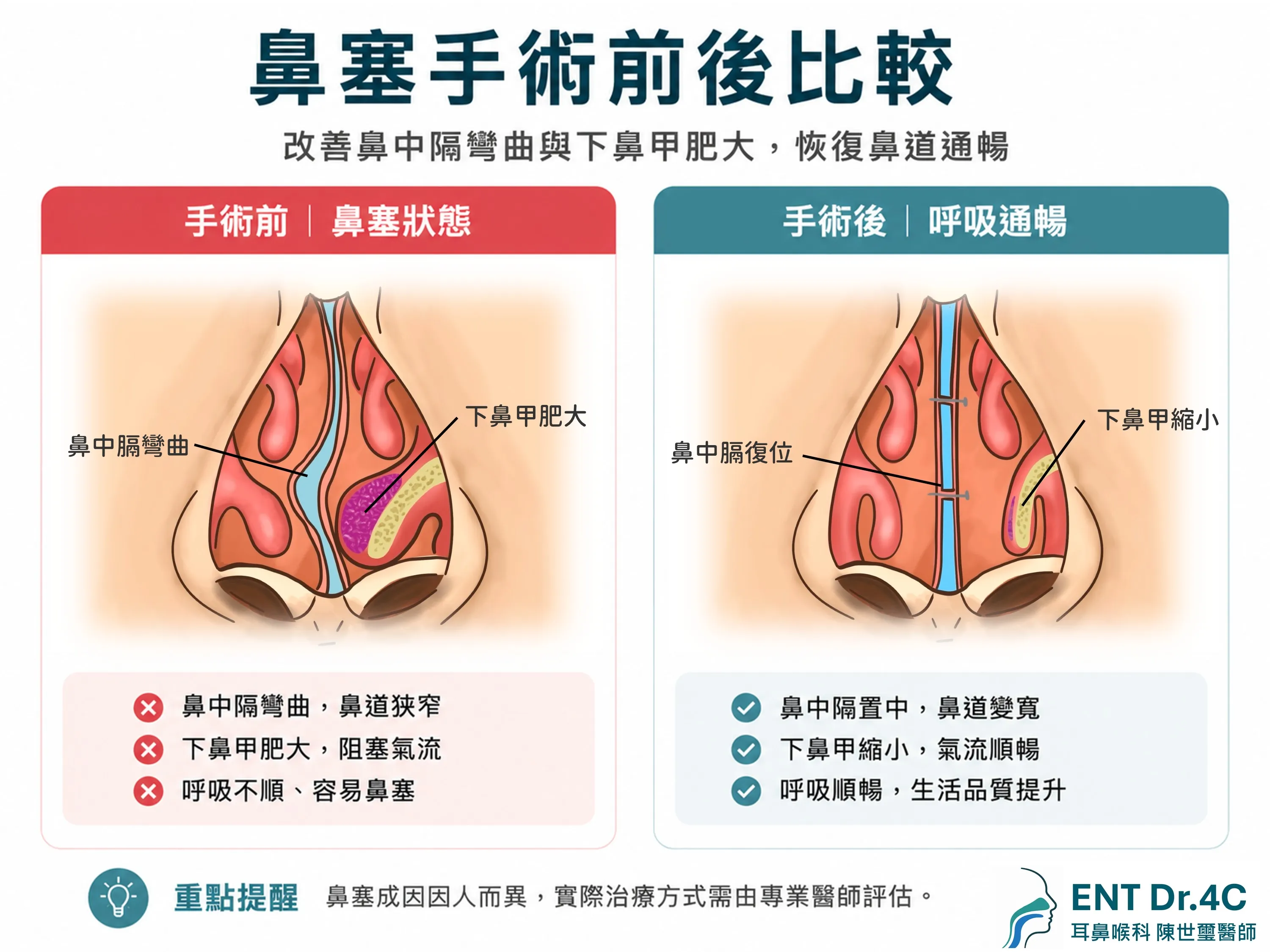 鼻塞手術前後比較示意圖：改善鼻中膈彎曲與下鼻甲肥大，恢復鼻道通暢
