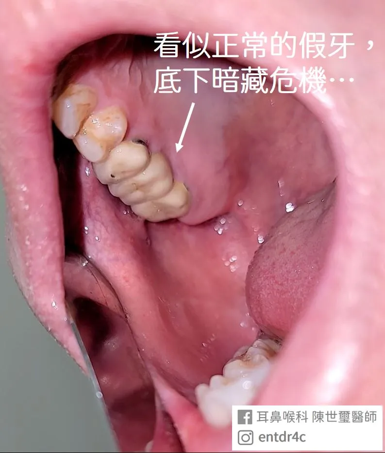 看似正常的假牙，底下暗藏危機
