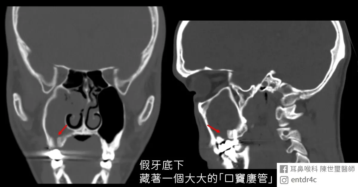 假牙底下的口竇廔管