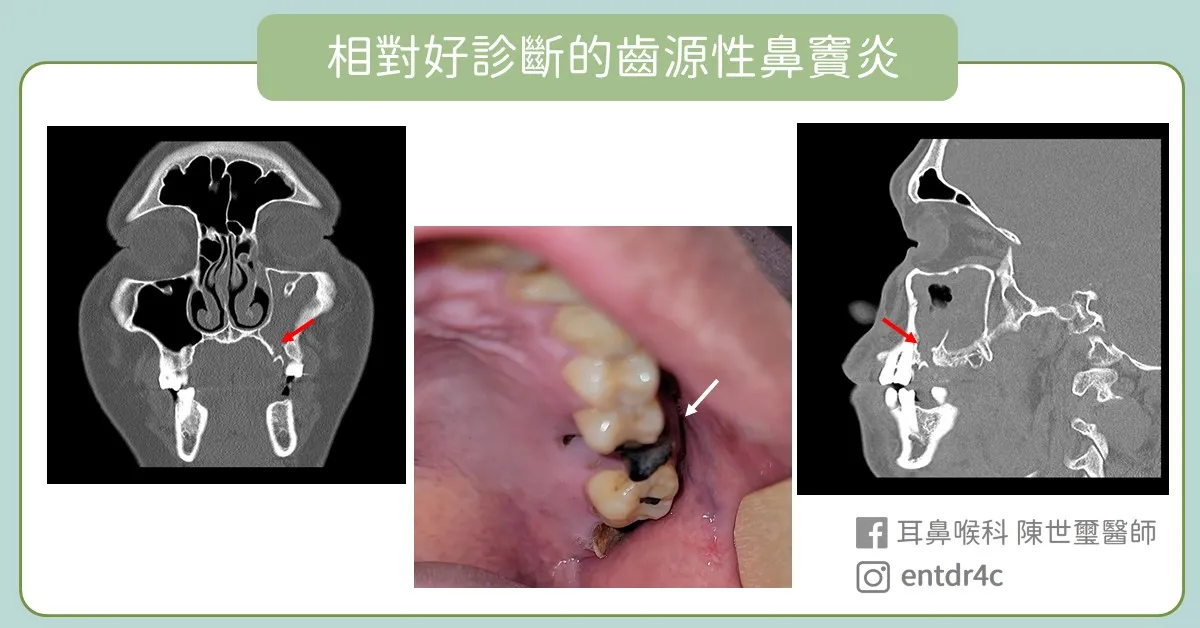 相對好診斷的齒源性鼻竇炎