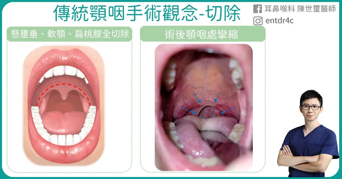02 傳統顎咽手術觀念-切除
