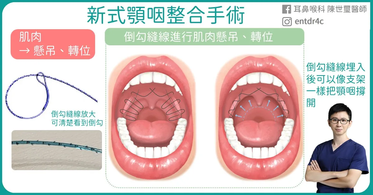 05 新式顎咽整合手術 倒勾線懸壅顎咽成形術