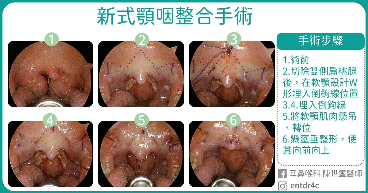 06 新式顎咽整合手術 手術步驟