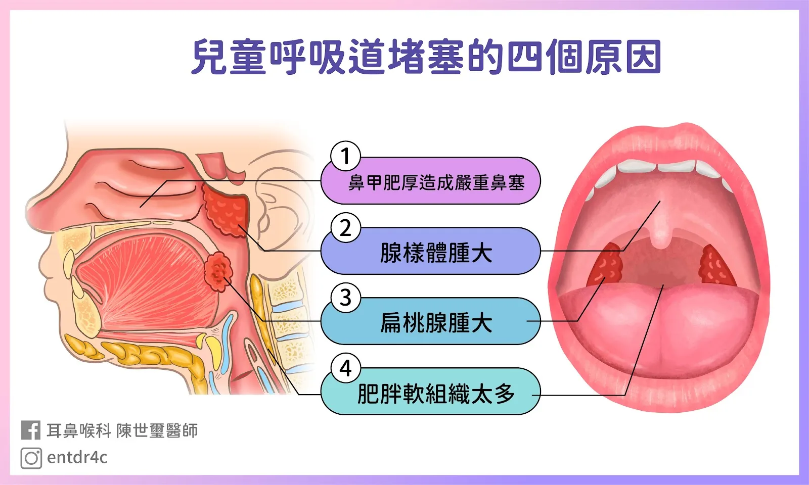 兒童呼吸道阻塞的四大關卡