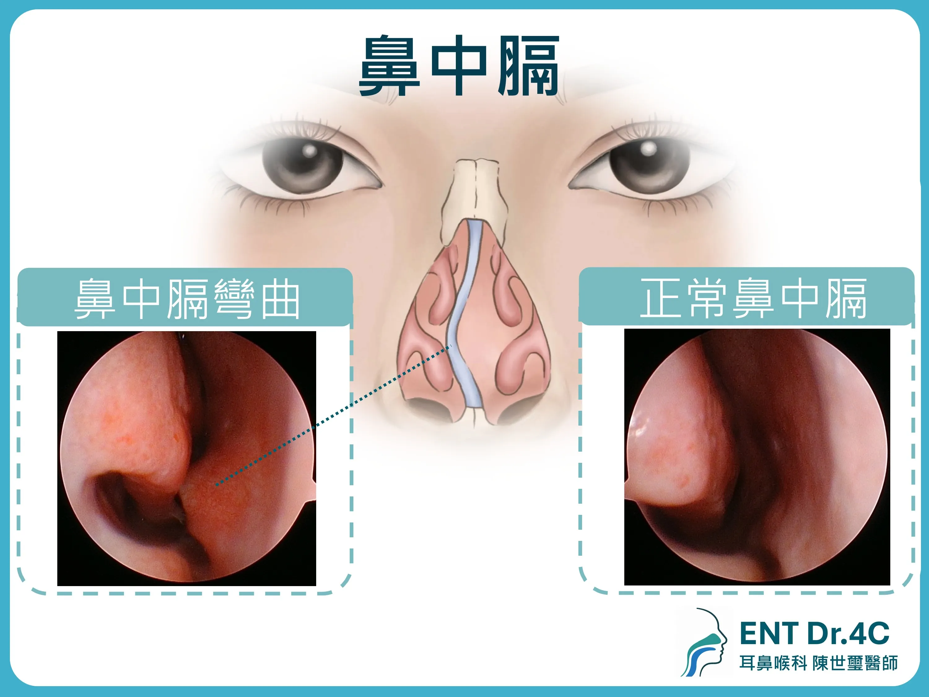 鼻中膈內視鏡比較：鼻中膈彎曲與正常鼻中膈