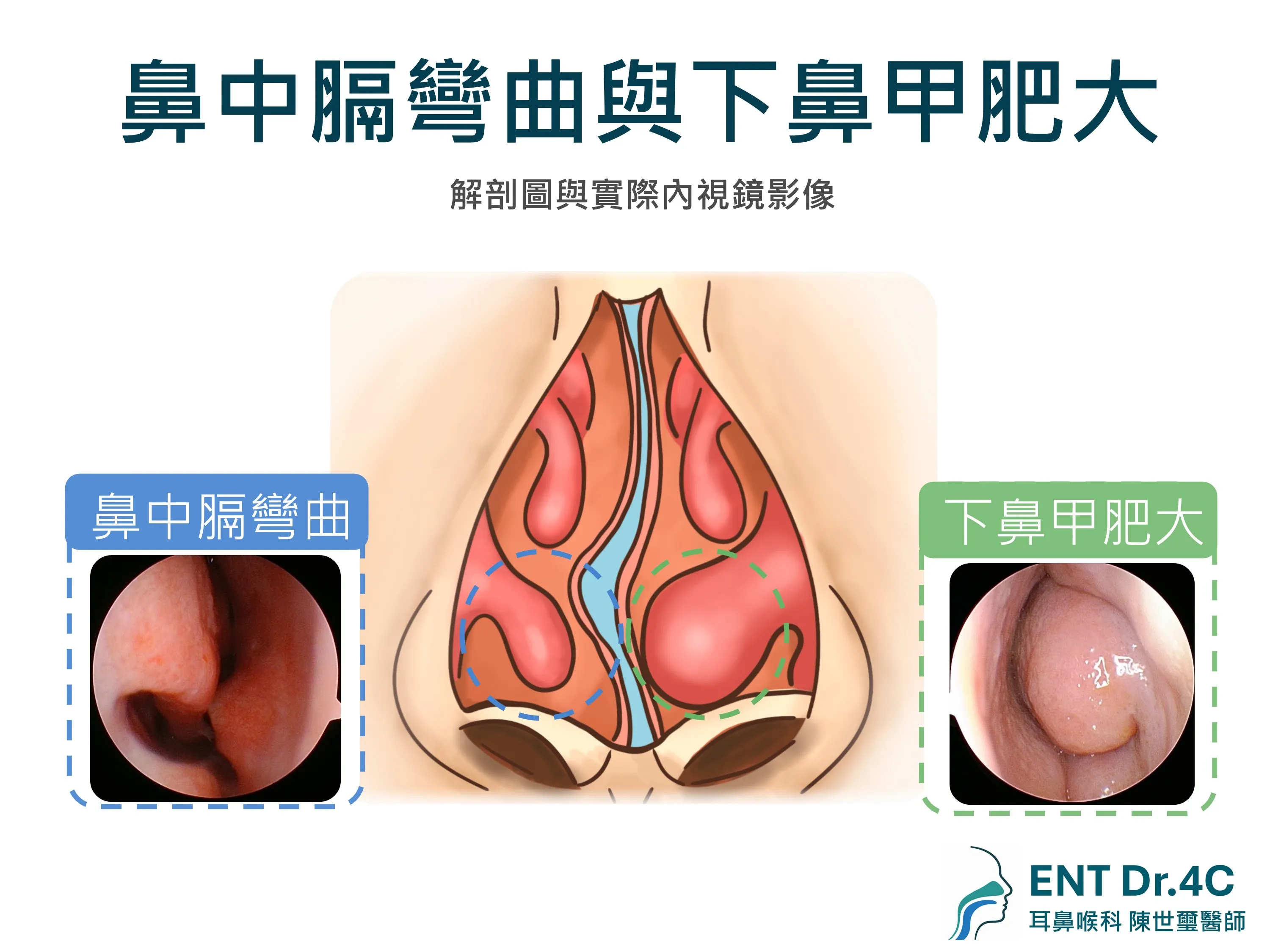 鼻中膈彎曲與下鼻甲肥大的解剖圖與實際內視鏡影像