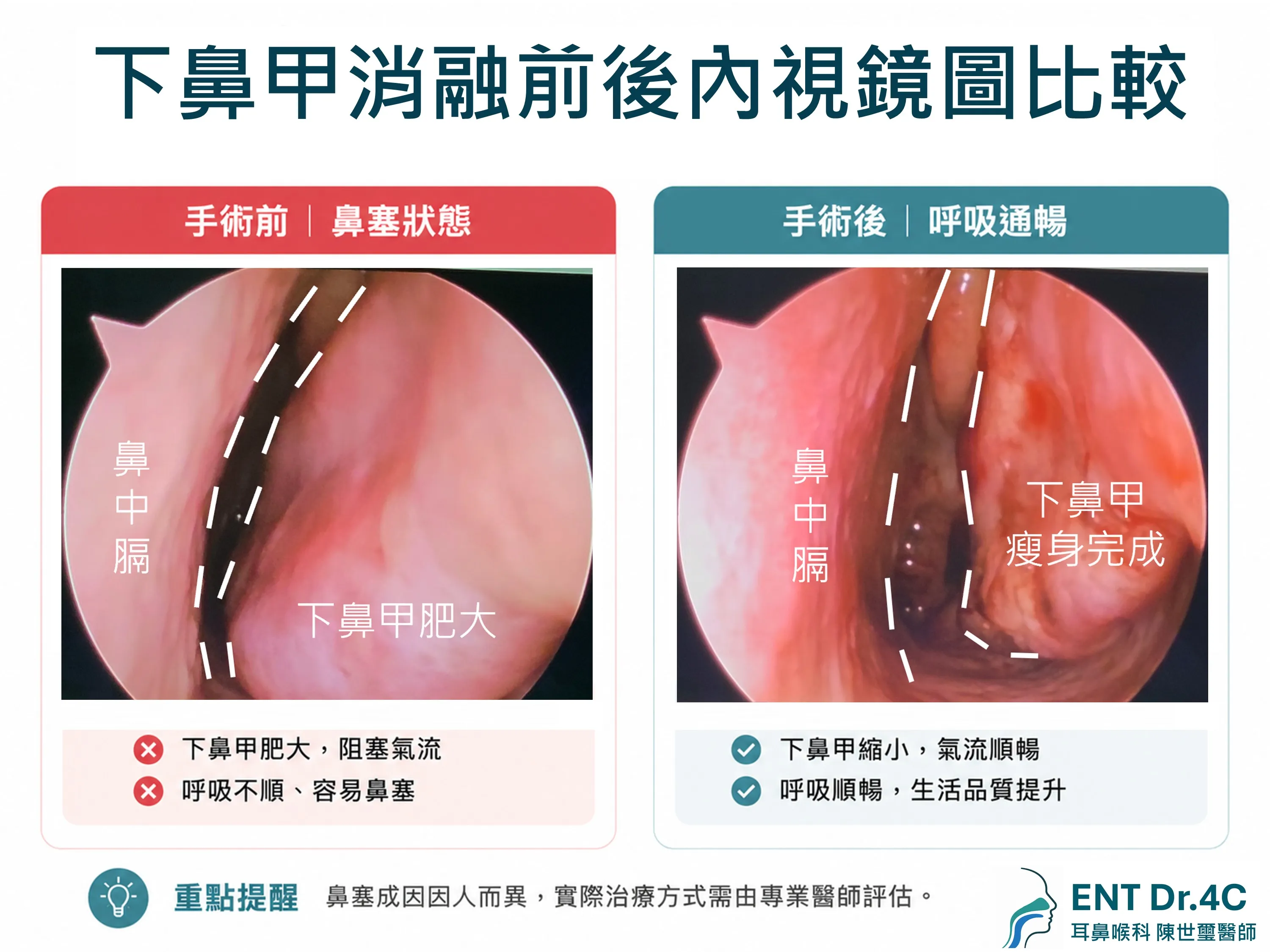 下鼻甲消融手術前後內視鏡影像比較：下鼻甲縮小、鼻道恢復通暢