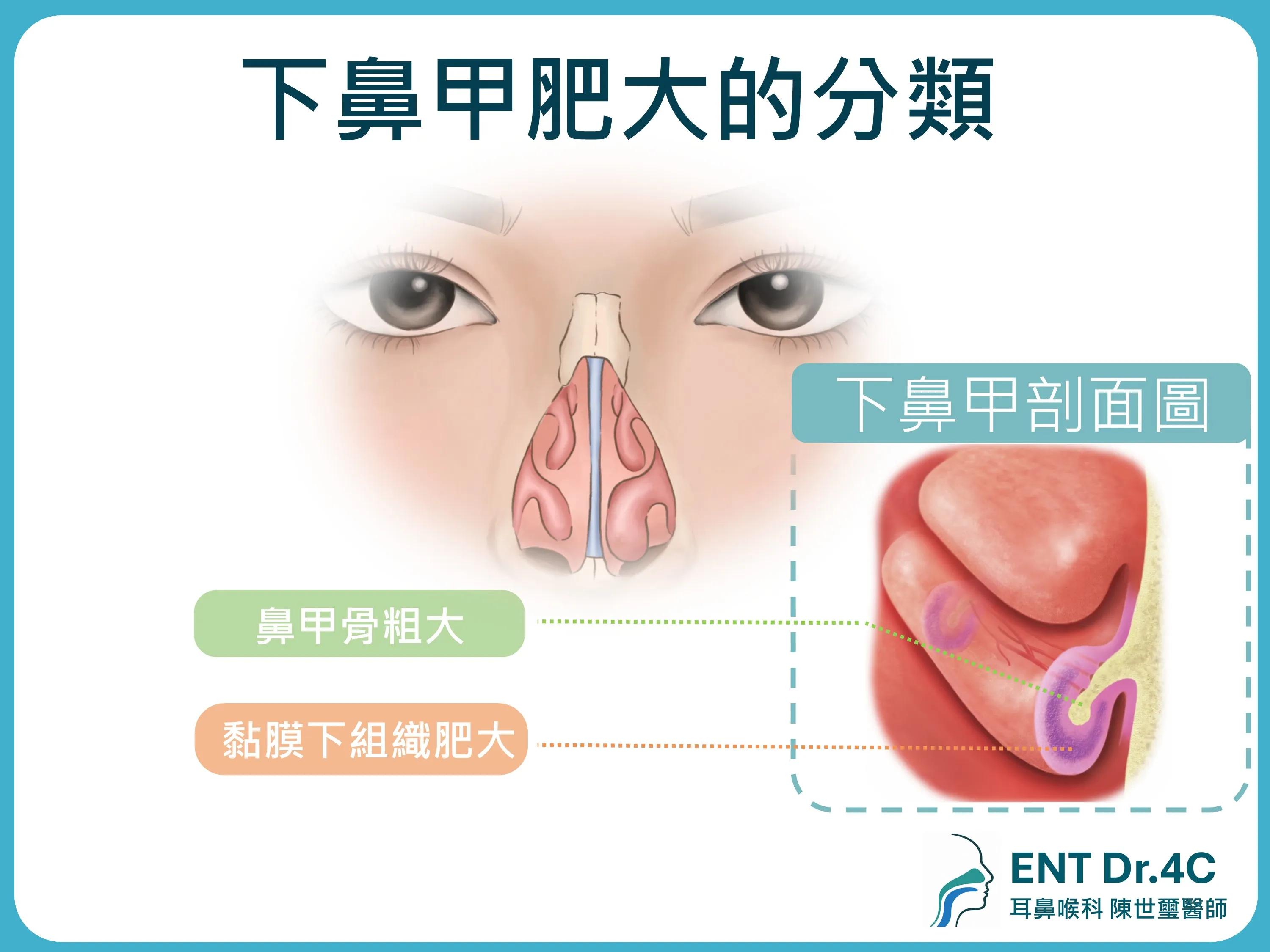 下鼻甲肥大的分類：鼻甲骨粗大與黏膜下組織肥大的剖面圖