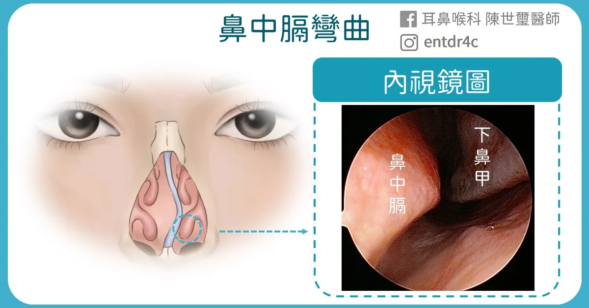 03 鼻中膈彎曲內視鏡圖