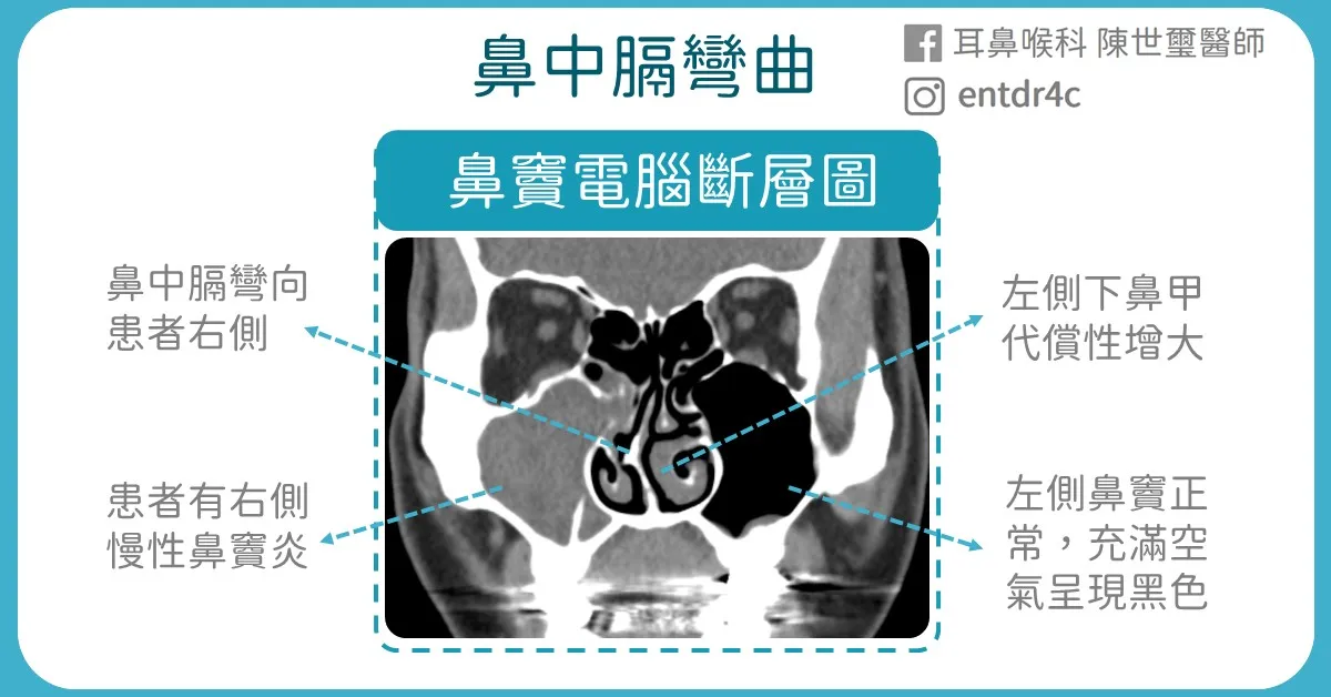 電腦斷層 右側鼻竇炎、鼻中膈彎向右側、左側下鼻甲代償性增大